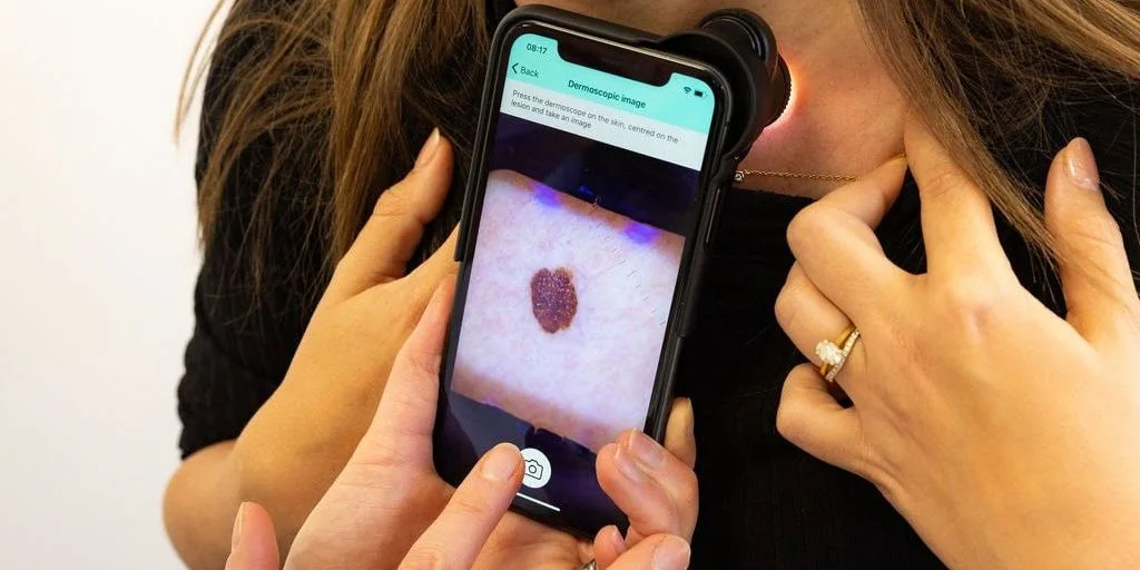 AI platform launched for early skin cancer detection